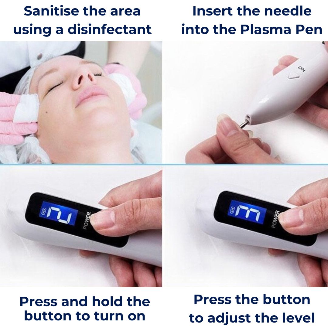 DermaGlow | Mole Removal Pen – Non-Invasive Plasma – Cordless & Rechargeable – At-Home Skin Tag & Freckle Treatment Stornfield