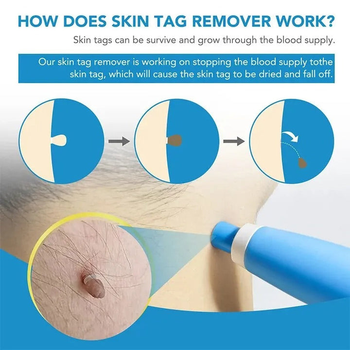 Stornfield | Ingrown Hair Removal Kit