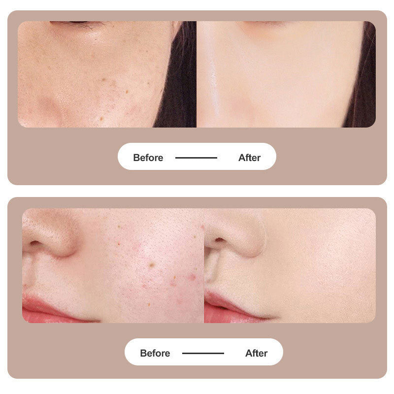 Plasma Pen for tattoo and mole removal | Stornfield