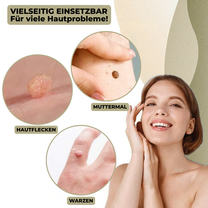 Stornfield | DermaLinx Wart Remover | Pain-Free Removal of Warts & Moles | For Home | Without Surgery