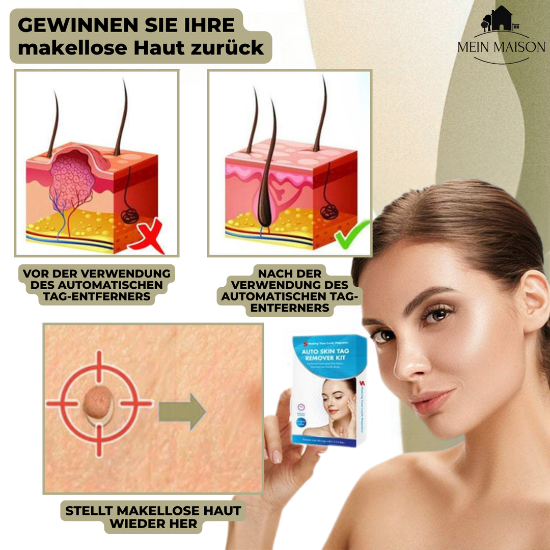 Stornfield | DermaLinx Wart Remover | Pain-Free Removal of Warts & Moles | For Home | Without Surgery