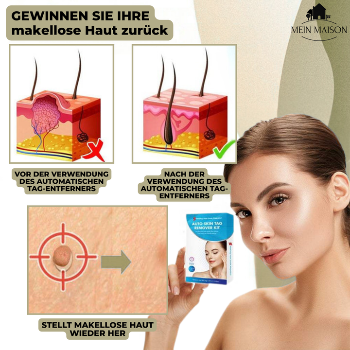 Stornfield | DermaLinx Wart Remover | Pain-Free Removal of Warts & Moles | For Home | Without Surgery
