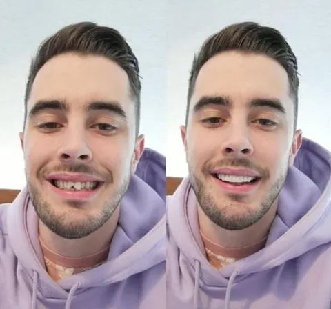 Stornfield | On Smile Veneers (Upper and Lower Jaw included)