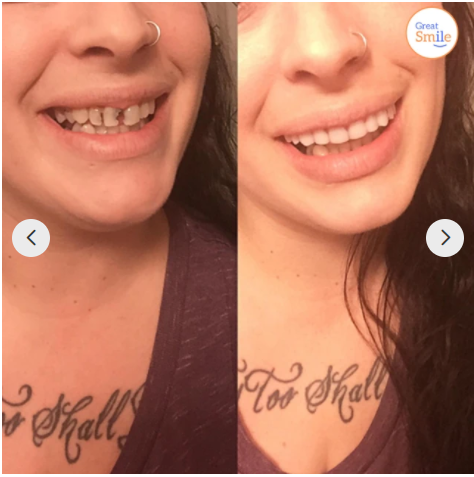Stornfield | Clip-In Dentures | Buy One, Get One Free!