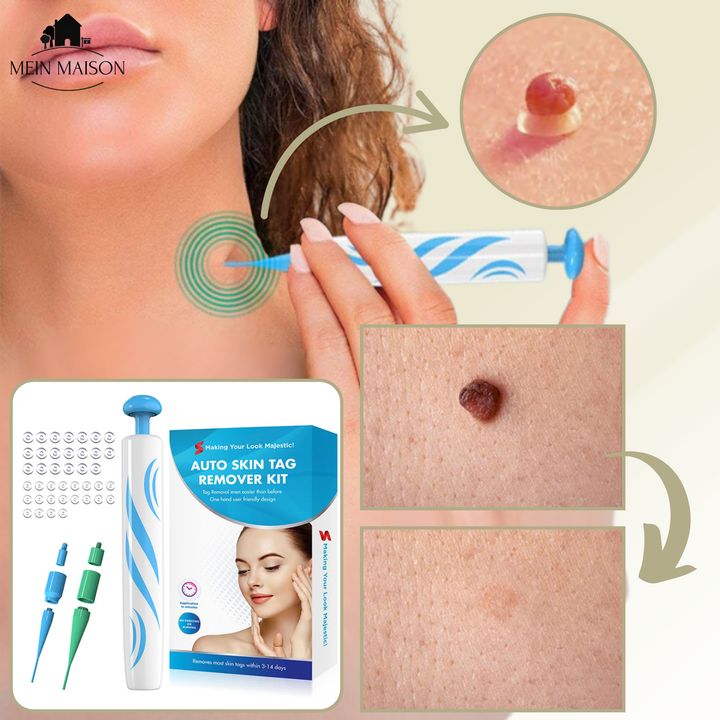 Stornfield | DermaLinx Wart Remover | Pain-Free Removal of Warts & Moles | For Home | Without Surgery