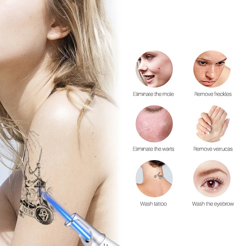 Stornfield | Smart Tattoo Removal Laser Pen - Remove moles, freckles, acne, tattoos
