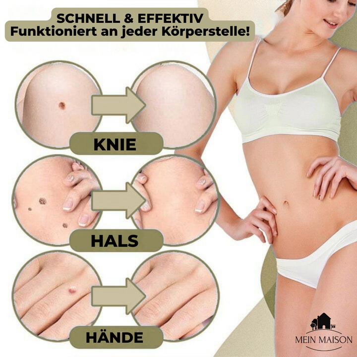 Stornfield | DermaLinx Wart Remover | Pain-Free Removal of Warts & Moles | For Home | Without Surgery
