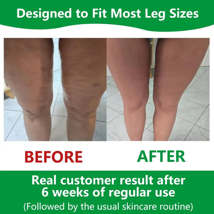 Stornfield | Sakerplus Cellulite Massage Roller
