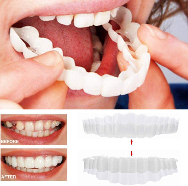Stornfield | On Smile Veneers (Upper and Lower Jaw included)
