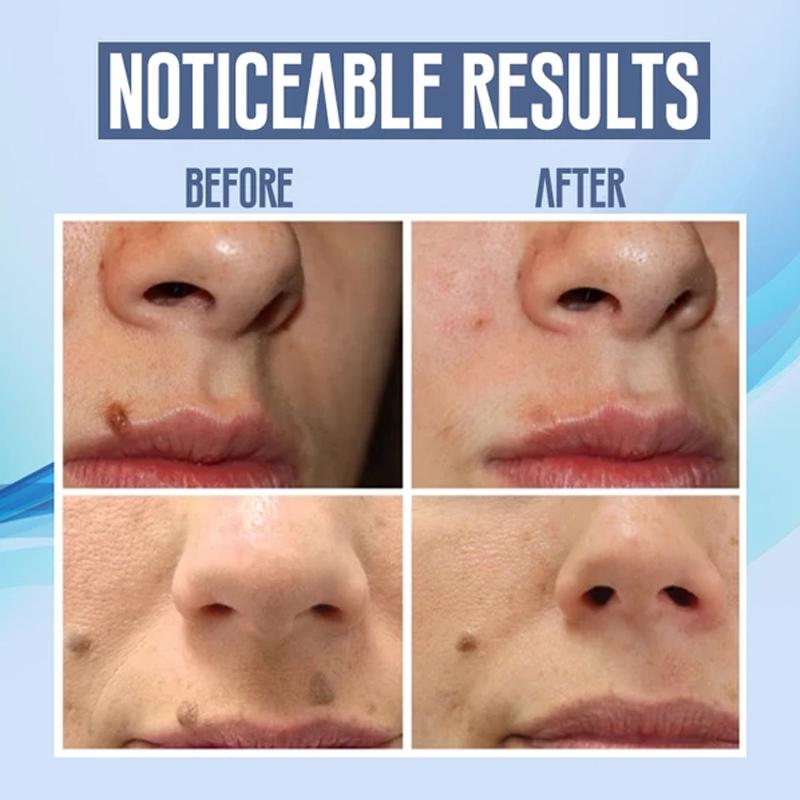 Stornfield | Facial Hair Removal Pen