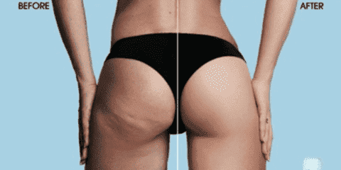 Anti Cellulite Vacuum Silicone Cups | Stornfield
