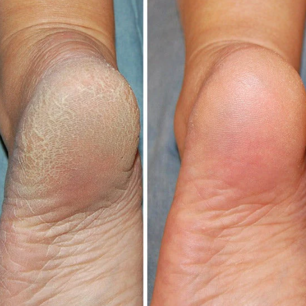 Stornfield | Silicon-Spa-Socks - Intensive care for cracked and tired feet