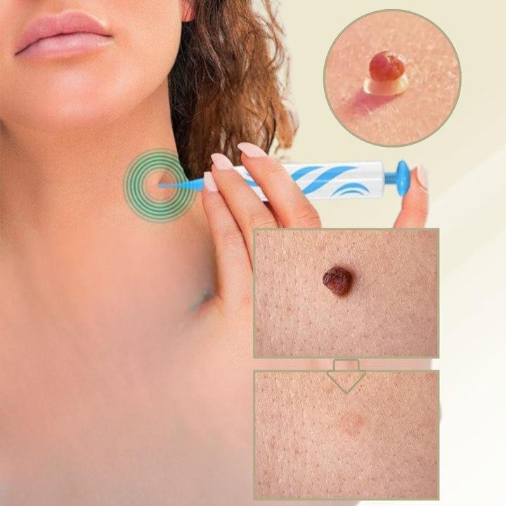 Stornfield | DermaLinx Wart Remover | Pain-Free Removal of Warts & Moles | For Home | Without Surgery