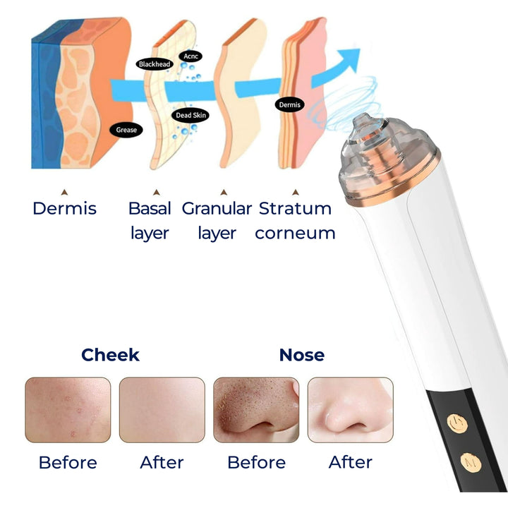 GlowEase | Microdermabrasion Kit - Blackhead Remover - USB Rechargeable - At-Home Skincare Solution Stornfield
