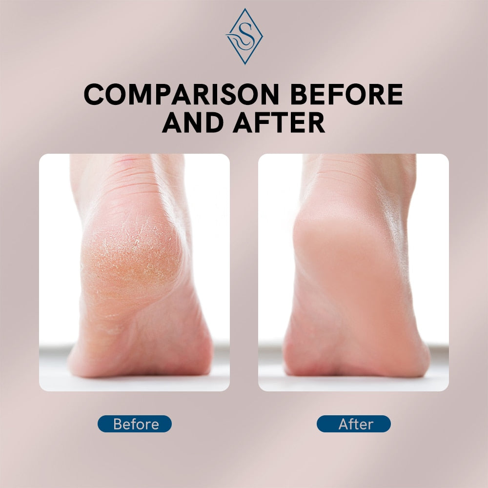 Electric Foot Callus Remover | Stornfield