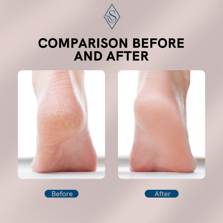 Electric Foot Callus Remover | Stornfield
