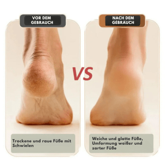 Electric foot care roller with USB battery | Stornfield