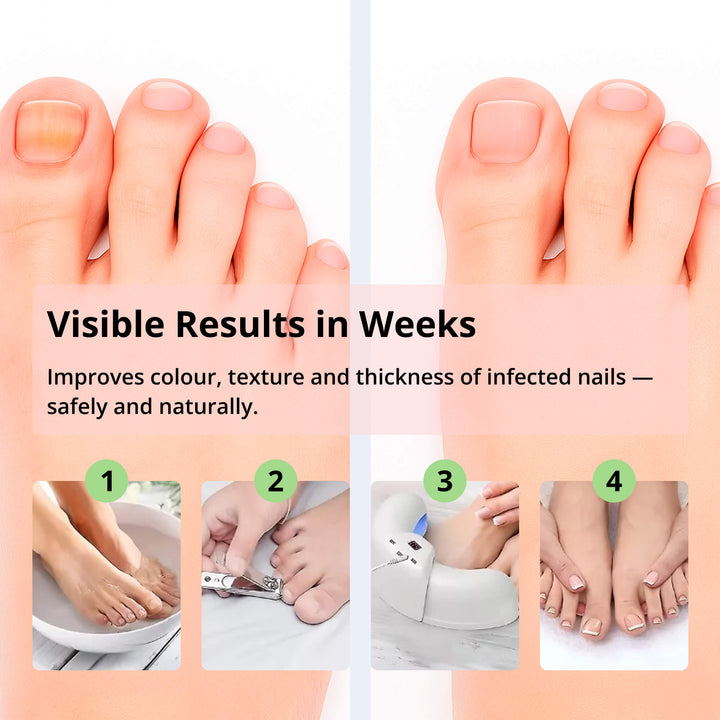 Stornfield | Laser Nail Fungus Removal Device | Advanced Home Treatment with Red & Blue Light for Healthy Nails
