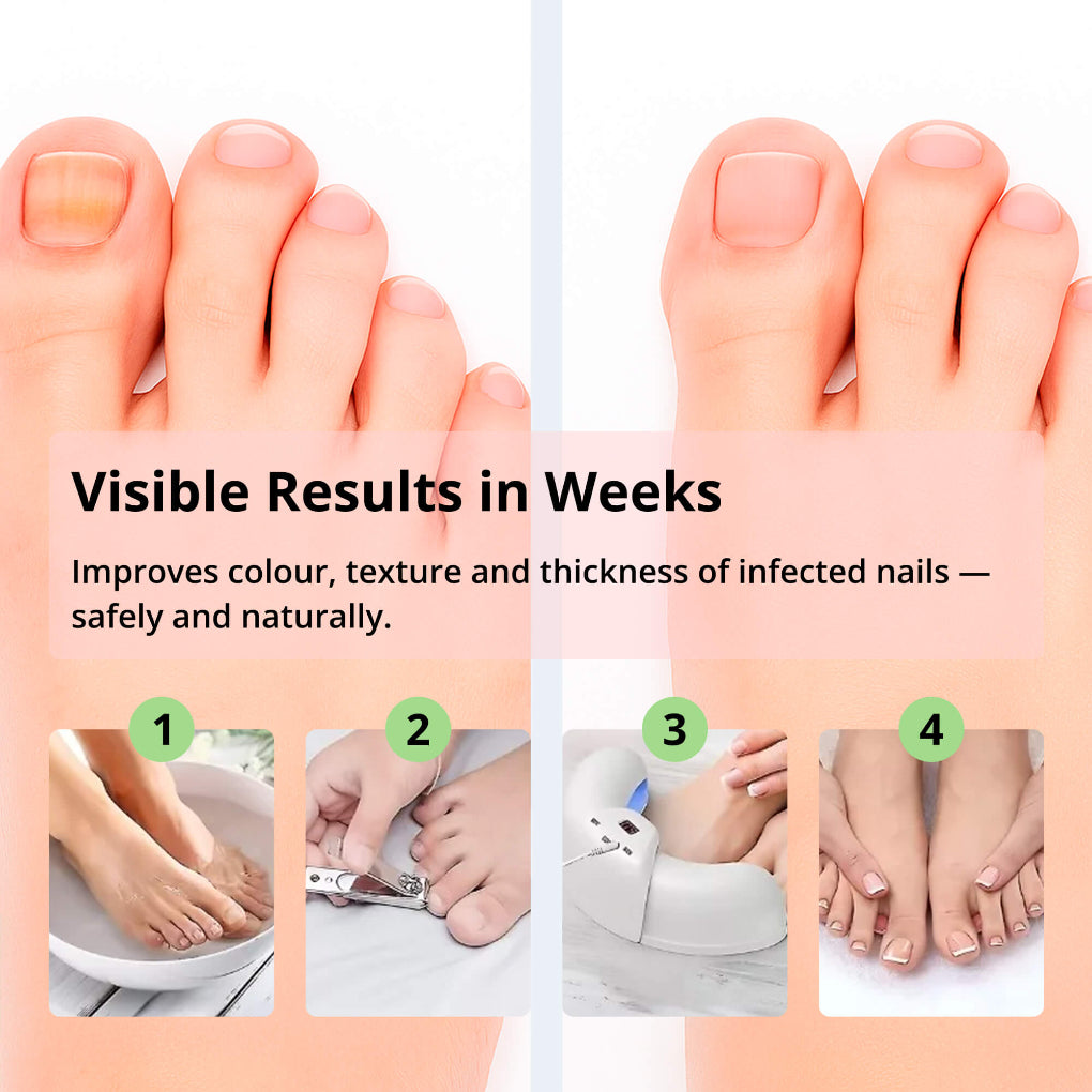 Laser Nail Treatment Device – Red and blue light against nail fungus | Stornfield