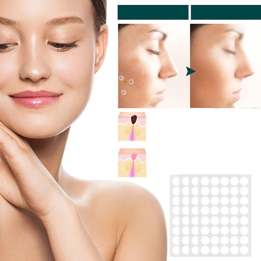Stornfield | SkinClear - Plaster for the removal of spots and warts