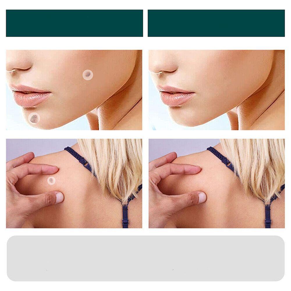 Stornfield | SkinClear - Plaster for the removal of spots and warts