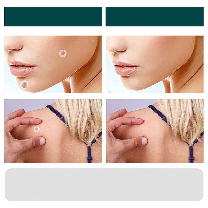 Stornfield | SkinClear - Plaster for the removal of spots and warts