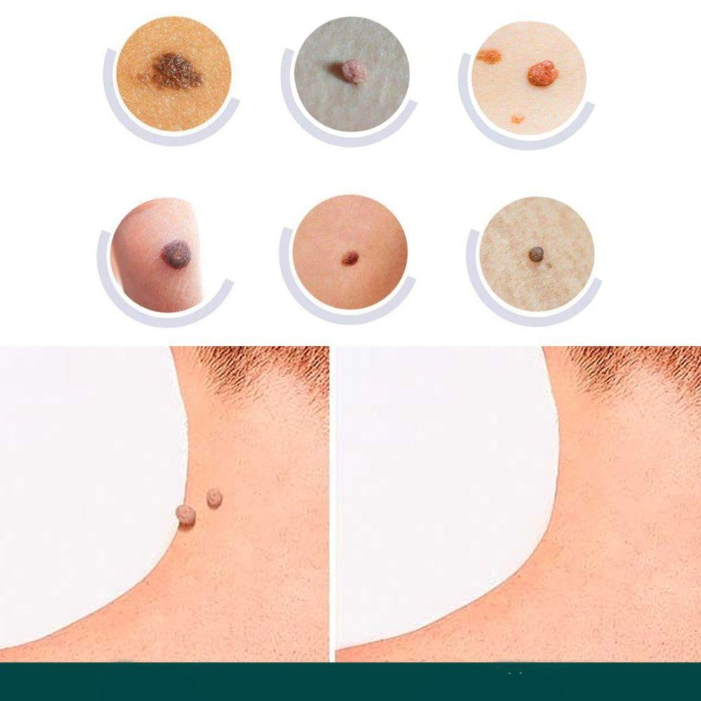 Stornfield | SkinClear - Plaster for the removal of spots and warts