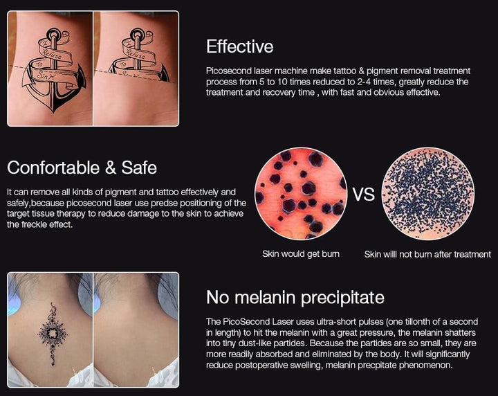 Stornfield | Instant Laser Dark Spot & Tattoo Remover