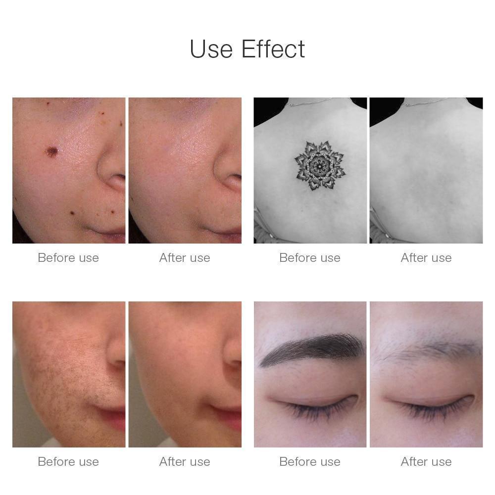 Stornfield | Instant Laser Dark Spot & Tattoo Remover
