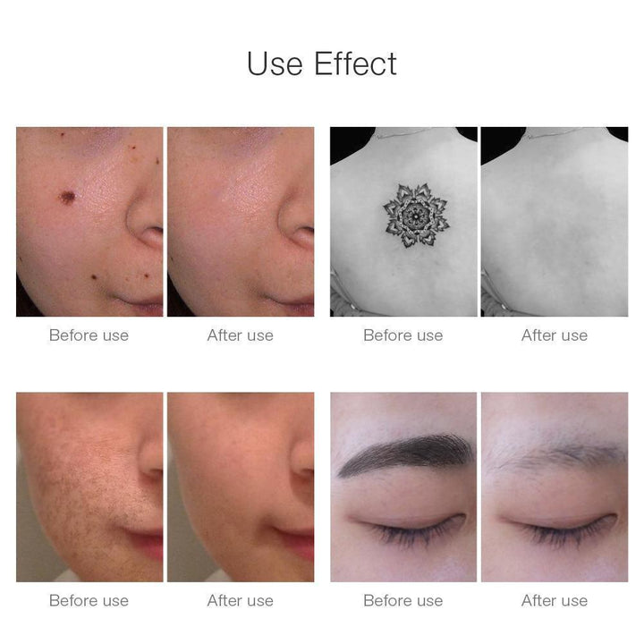 Stornfield | Instant Laser Dark Spot & Tattoo Remover