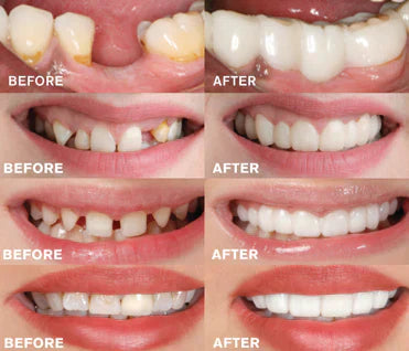 Stornfield | Clip-In Dentures | Buy One, Get One Free!