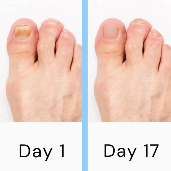 Stornfield | Nail Laser Fungus Device