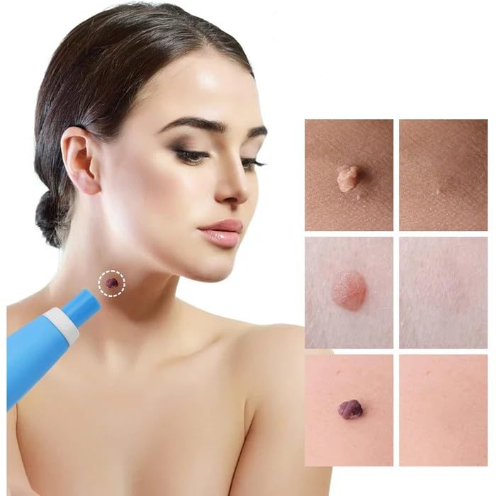 Skin Tag Remover Kit | Non-invasive & Effective | Stornfield