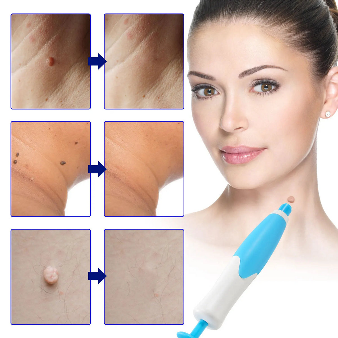 Skin Tag Remover Kit | Non-invasive & Effective | Stornfield