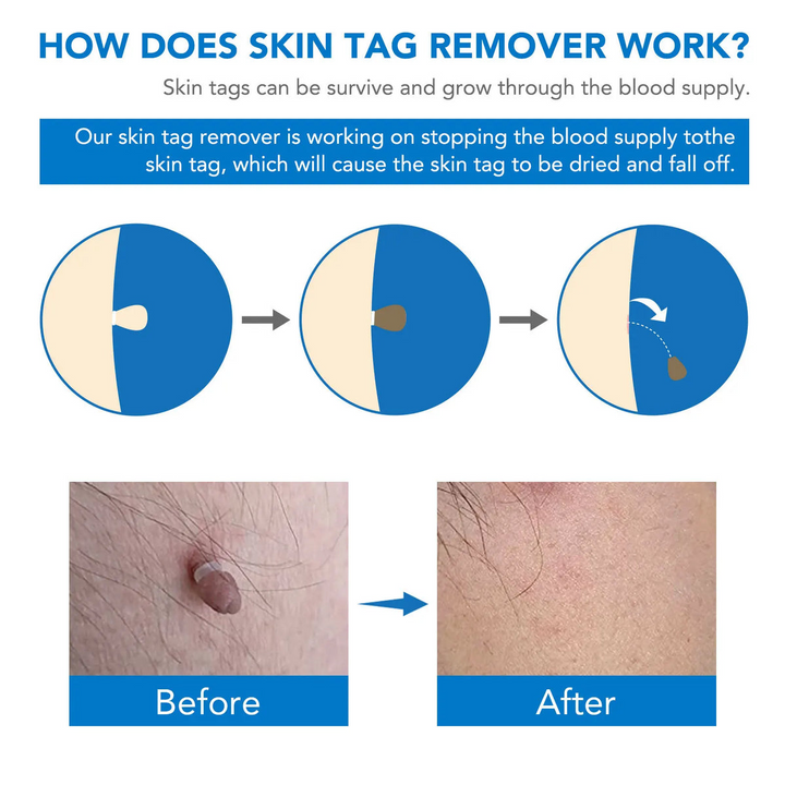 Skin Tag Remover Kit | Non-invasive & Effective | Stornfield
