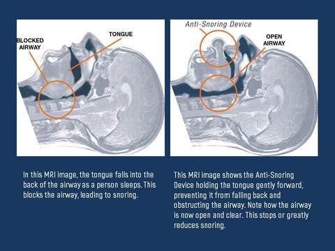 Stornfield | Apnea Tongue Stabilizing Device