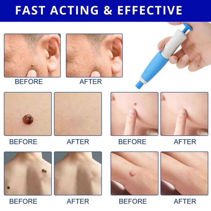 Skin Tag Remover Kit | Non-invasive & Effective | Stornfield