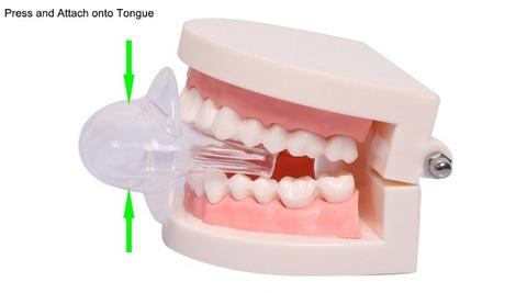 Stornfield | Apnea Tongue Stabilizing Device