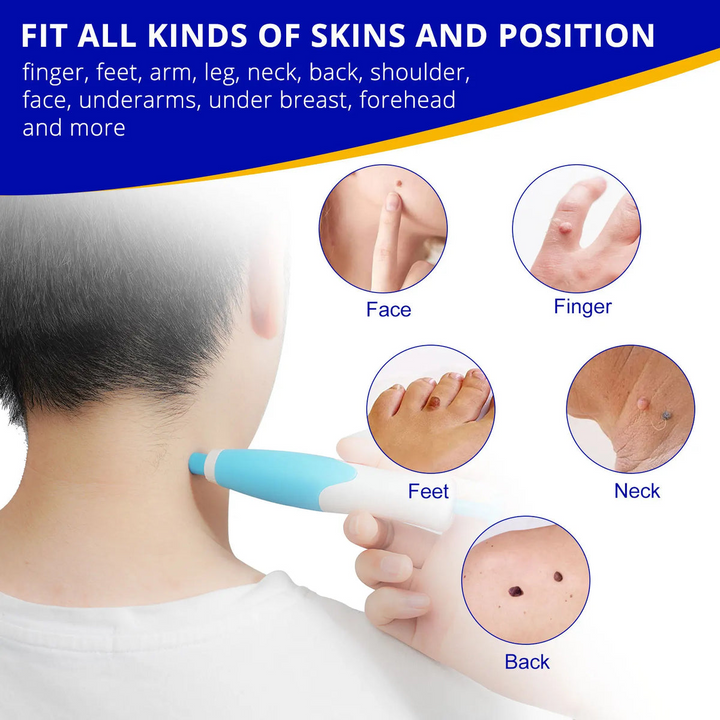 Skin Tag Remover Kit | Non-invasive & Effective | Stornfield