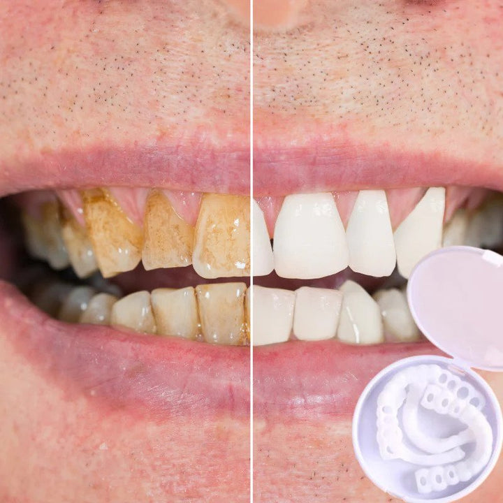 Stornfield | SmileSnap - Always the perfect smile with these veneers