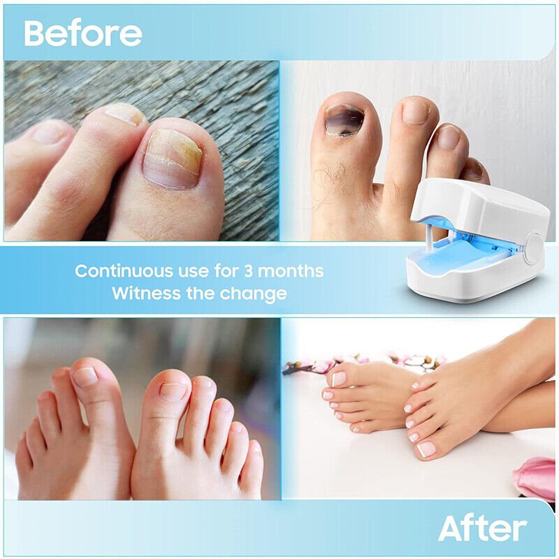 Stornfield | Laser Device for Nail Fungus Removal – Expert's Highly Effective Revolutionary Light Therapy Device for Toenail Problems