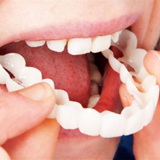 Stornfield | SmileSnap - Always the perfect smile with these veneers